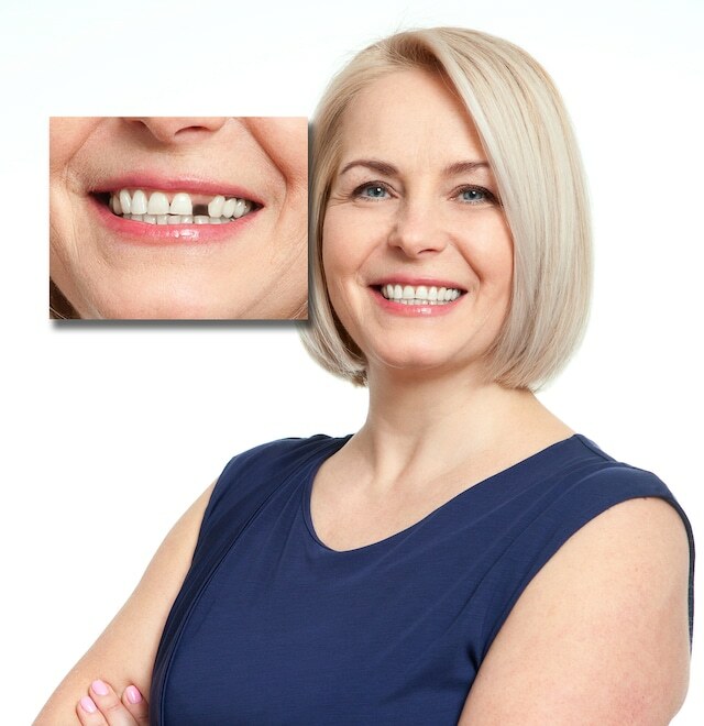 インスタントスマイル テンポラリートゥースキット 3色入